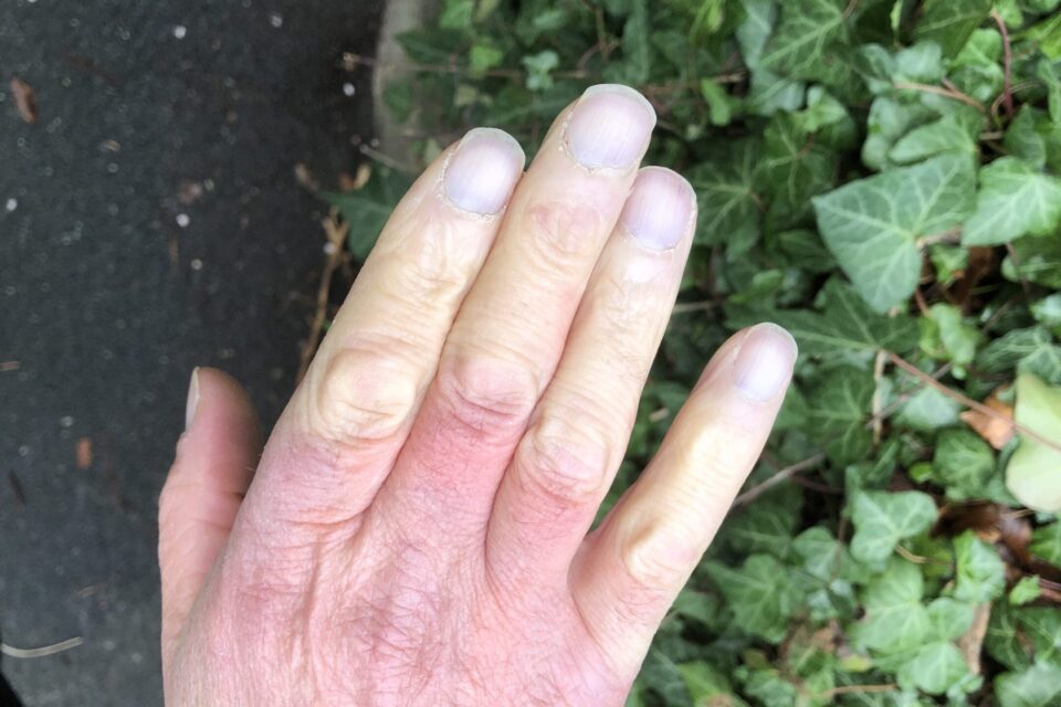 Hand with white finger tips