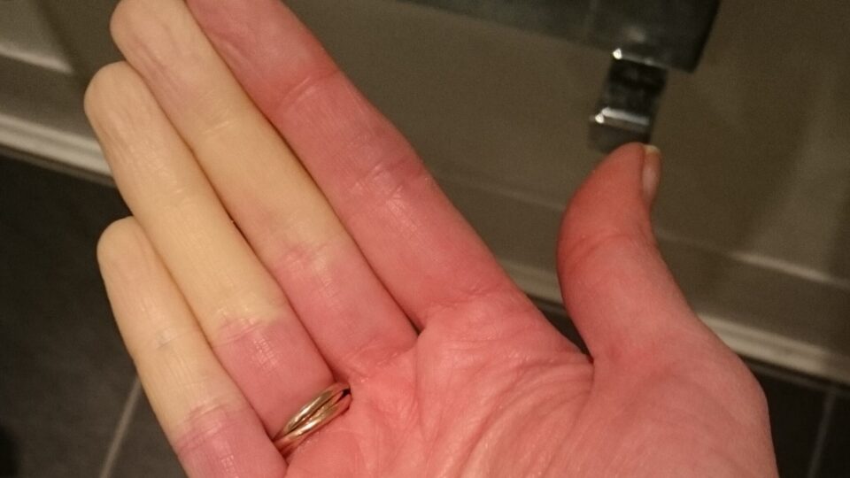 Raynaud's presenting in three fingers on a woman's hand