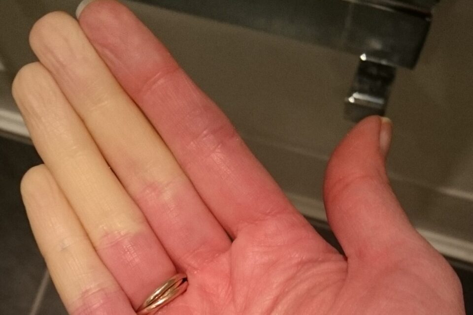 Raynaud's presenting in three fingers on a woman's hand