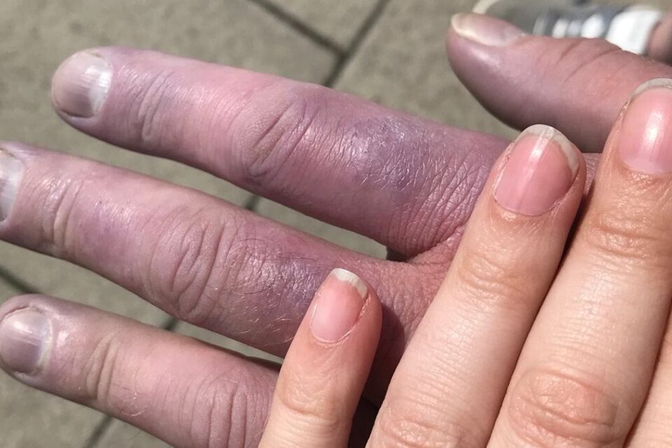 two hands, one is blue to show a Raynaud's attack