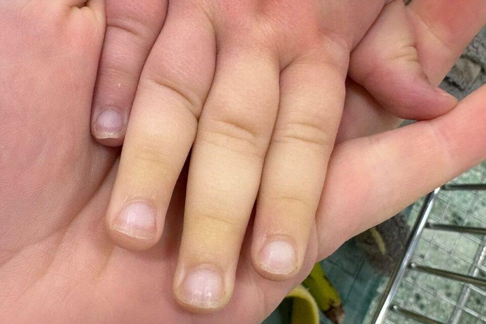 A small child's hand showing symptoms of Raynaud's, is resting on their parent's hand, and shows the colour contrast from pink to white skin.