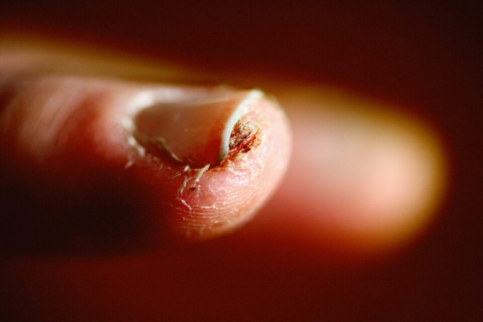 A finger with a sore under the fingernail