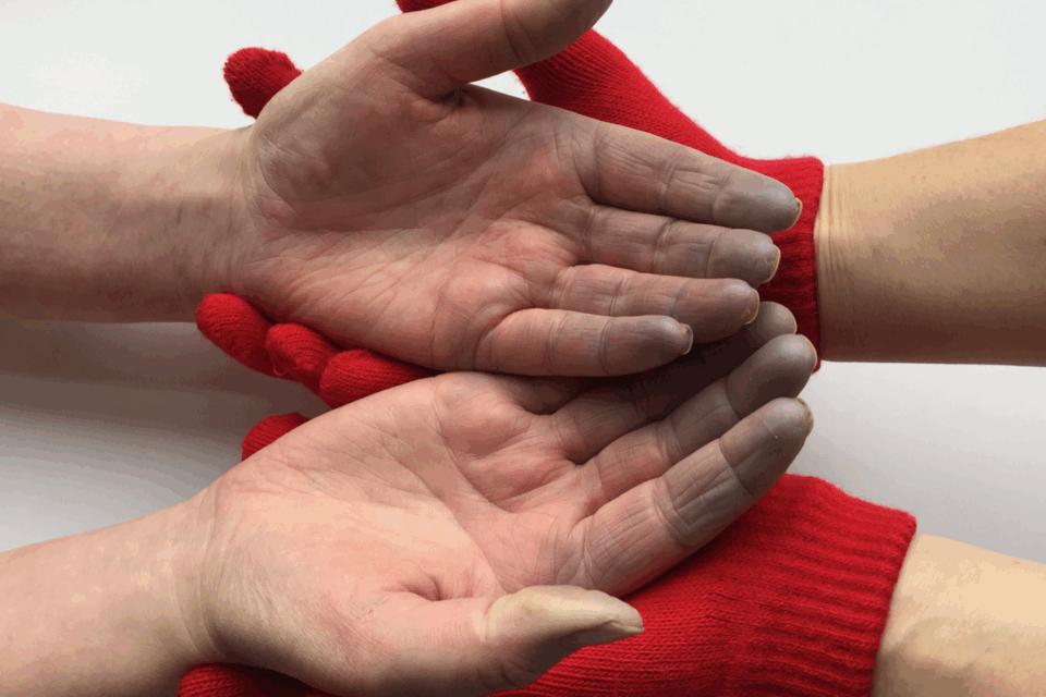 gloved hands holding hands with blue fingers from a Raynaud's attack