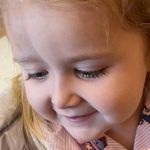 A close up of a young girl with a slight indent on her forehead - a sign of scleroderma