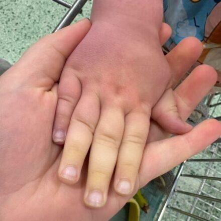 A small child's hand showing symptoms of Raynaud's, is resting on their parent's hand, and shows the colour contrast from pink to white skin.