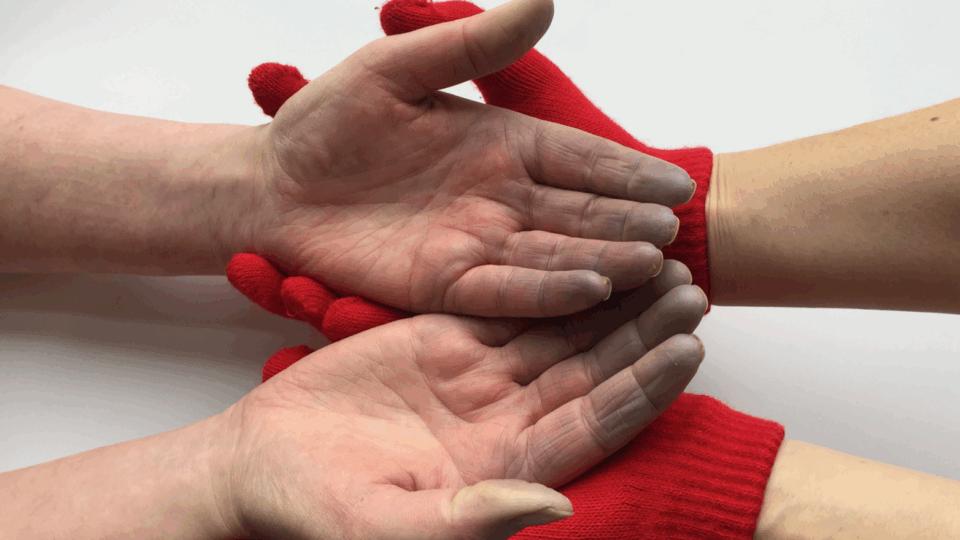 gloved hands holding hands with blue fingers from a Raynaud's attack